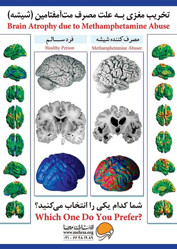 پوستر تخریب مغزی به علت مصرف مت‌آمفتامین (شیشه)